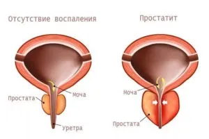 Герпес в паху у чоловіків і жінок симптоми, лікування, фото (паху) Герпес в паху у чоловіків і жінок симптоми, лікування, фото