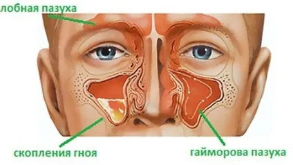 Головний біль при гаймориті - симптоми, що робити, ніж лікувати (головний біль при гаймориті) Головний біль при гаймориті - симптоми, що робити, ніж лікувати