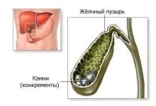Як визначити камені в жовчному міхурі (визначити) Як визначити камені в жовчному міхурі