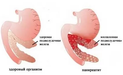 Як зупинити пронос при панкреатиті способи, фітотерапія (зупинити) Як зупинити пронос при панкреатиті способи, фітотерапія