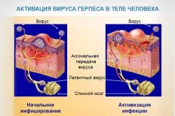 Рецидивуючий герпес що важливо знати, лікування, клінічна картина (фото і відео) (знати) Рецидивуючий герпес що важливо знати, лікування, клінічна картина (фото і відео)