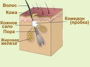 Як прибрати пори на обличчі (Чому розширюються пори) Як прибрати пори на обличчі