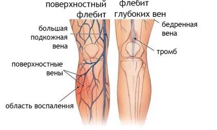 Як зняти запалення вен - причини, симптоми, лікування, профілактика (запалення) Як зняти запалення вен - причини, симптоми, лікування, профілактика