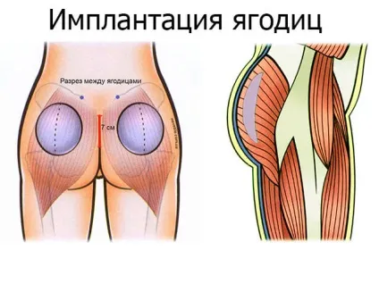 Як збільшити сідниці без операції і хірургічно, за допомогою імплантації сідниць (хірургічно) Як збільшити сідниці без операції і хірургічно, за допомогою імплантації сідниць