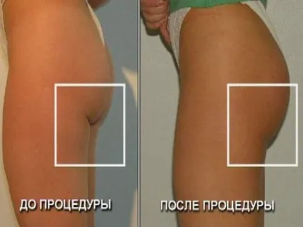 Як збільшити сідниці без операції і хірургічно, за допомогою імплантації сідниць (допомогою) Як збільшити сідниці без операції і хірургічно, за допомогою імплантації сідниць