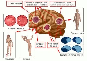 Класифікація пухлин, рак - лікування і профілактика (лікування) Класифікація пухлин, рак - лікування і профілактика