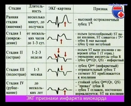 Клінічні варіанти інфаркту міокарда (клінічні) Клінічні варіанти інфаркту міокарда