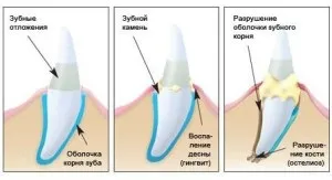 Кровоточать ясна - що робити причини і лікування кровоточивості полосканнями (кровоточать) Кровоточать ясна - що робити причини і лікування кровоточивості полосканнями