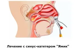Лікування гаймориту ЯМІК методом (лікування) Лікування гаймориту ЯМІК методом