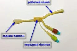 Лікування гаймориту ЯМІК методом (методом) Лікування гаймориту ЯМІК методом