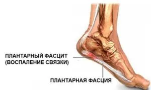 Лікування п'яткової шпори лазером відгуки, курс лікування і протипоказання (лазером) Лікування п'яткової шпори лазером відгуки, курс лікування і протипоказання