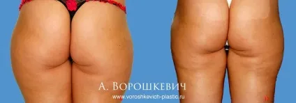 Ліпосакція зон тіла