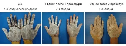 Лікування гіпергідрозу хірургічні та косметологічні методики