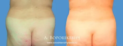 Ліпосакція зон тіла