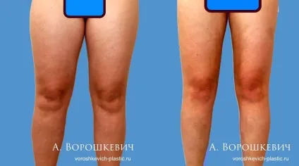 Ліпосакція зон тіла