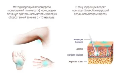Лікування гіпергідрозу хірургічні та косметологічні методики