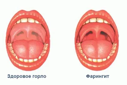 Ларингіт і фарингіт відміну
