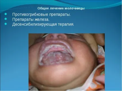 Лікування молочниці у немовлят, новонароджених, немовлят