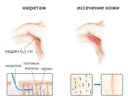 Лікування гіпергідрозу хірургічні та косметологічні методики