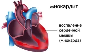 Міокардит - етіологія, патогенез, діагностика, лікування, профілактика, здоров'я і медицина (етіологія) Міокардит - етіологія, патогенез, діагностика, лікування, профілактика, здоров'я і медицина