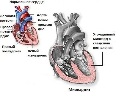 Міокардит - етіологія, патогенез, діагностика, лікування, профілактика, здоров'я і медицина (профілактика) Міокардит - етіологія, патогенез, діагностика, лікування, профілактика, здоров'я і медицина