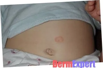 Рожевий лишай у дітей симптоми, лікування і фото (домашніх) Рожевий лишай у дітей симптоми, лікування і фото