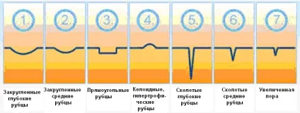 Рубці після прищів причини, види