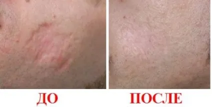 Рубці після опіків - як з ними правильно боротися найефективніші шляхи лікування (рубці) Рубці після опіків - як з ними правильно боротися найефективніші шляхи лікування