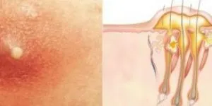 Народна медицина - настоянка з лопуха (медицина) Народна медицина - настоянка з лопуха