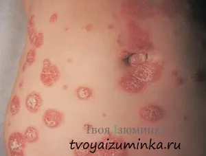 Чи можна вилікувати псоріаз