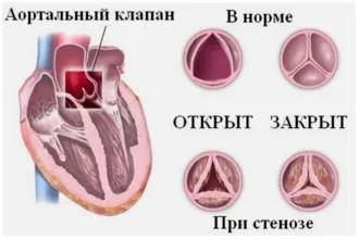 Недостатність аортального клапана - лікування і симптоми, ступеня у дітей і дорослих (клапана) Недостатність аортального клапана - лікування і симптоми, ступеня у дітей і дорослих