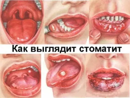 Ністатин при стоматиті призначення, протипоказання (ністатин) Ністатин при стоматиті призначення, протипоказання