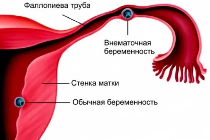 Чи обов'язково видалення труби при позаматкової вагітності (маткова труба) Чи обов'язково видалення труби при позаматкової вагітності
