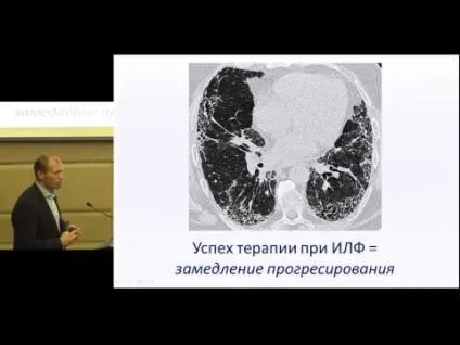 Вогнищевий фіброз легенів що це таке, лікування локальних змін, симптоми і діагностика (вогнищевий) Вогнищевий фіброз легенів що це таке, лікування локальних змін, симптоми і діагностика