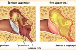 Отит у новонародженого симптоми, причини і лікування отиту (фото) (новонародженого) Отит у новонародженого симптоми, причини і лікування отиту (фото)