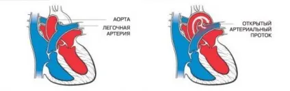 Відкрита артеріальна протока симптоми, діагностика та лікування (протока) Відкрита артеріальна протока симптоми, діагностика та лікування