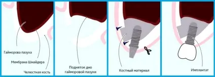 Відкритий синус ліфтинг операція