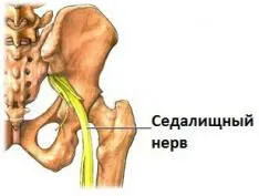 Перелом сідничної кістки - лікування, наслідки (лікування) Перелом сідничної кістки - лікування, наслідки