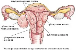 Плацентарна недостатність лікування, симптоми, причини і види (недостатність) Плацентарна недостатність лікування, симптоми, причини і види