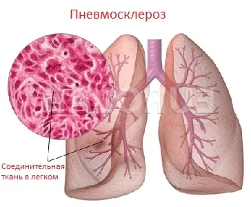 Пневмосклероз - тривалість життя, причини, лікування, результат