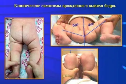 Підвивих тазостегнового суглоба у дітей та його лікування у новонароджених