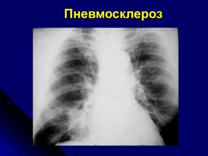 Пневмосклероз - тривалість життя, причини, лікування, результат