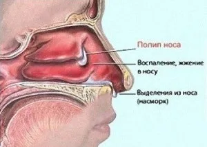 Поліпозно гайморит причини виникнення та методи усунення (оскільки медикаментозні препарати) Поліпозно гайморит причини виникнення та методи усунення
