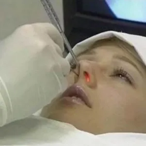 Поліпи в гайморових пазухах - лікування і симптоми захворювання (поліпи) Поліпи в гайморових пазухах - лікування і симптоми захворювання