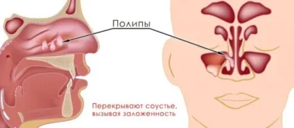 Поліпозно синусит симптоми і лікування, профілактика і можливі ускладнення (профілактика) Поліпозно синусит симптоми і лікування, профілактика і можливі ускладнення