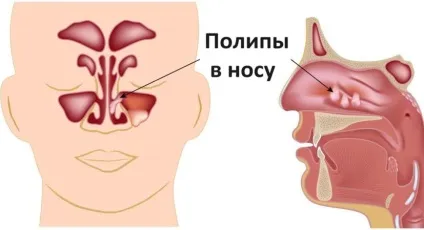 Поліпи в гайморових пазухах - лікування і симптоми захворювання (лікування) Поліпи в гайморових пазухах - лікування і симптоми захворювання
