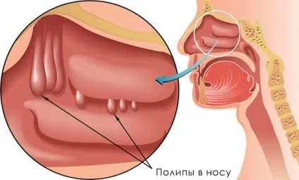 Поліпи в гайморової пазухи опис, симптоми, лікування (гайморової) Поліпи в гайморової пазухи опис, симптоми, лікування