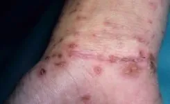 Прищ на долоні фото, причини, лікування прищів на долонях (прищ) Прищ на долоні фото, причини, лікування прищів на долонях