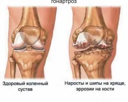 Причини болю в колінному суглобі і їх лікування (болю) Причини болю в колінному суглобі і їх лікування