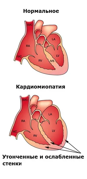 Причина смерті алкогольна кардіоміопатія (алкогольної кардіоміопатіческой форми) Причина смерті алкогольна кардіоміопатія